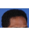 After Hair Transplant&nbsp;Front